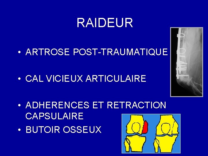 RAIDEUR • ARTROSE POST-TRAUMATIQUE • CAL VICIEUX ARTICULAIRE • ADHERENCES ET RETRACTION CAPSULAIRE •