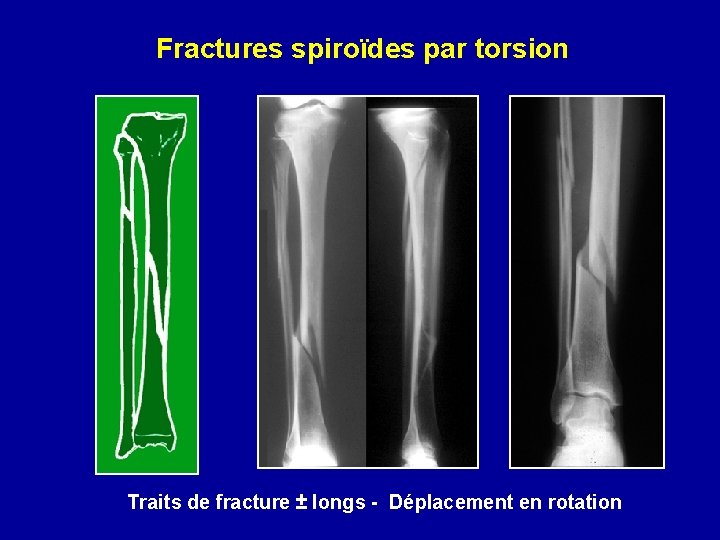 Fractures spiroïdes par torsion Traits de fracture ± longs - Déplacement en rotation 