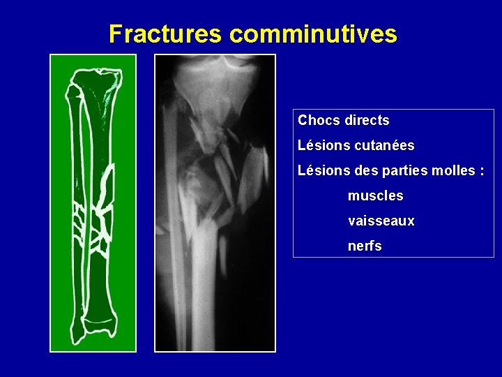 Fractures comminutives Chocs directs Lésions cutanées Lésions des parties molles : muscles vaisseaux nerfs