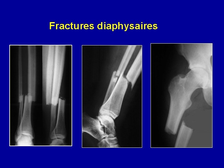 Fractures diaphysaires 