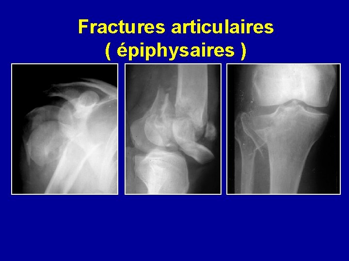 Fractures articulaires ( épiphysaires ) 