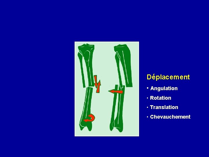 Déplacement • Angulation • Rotation • Translation • Chevauchement 