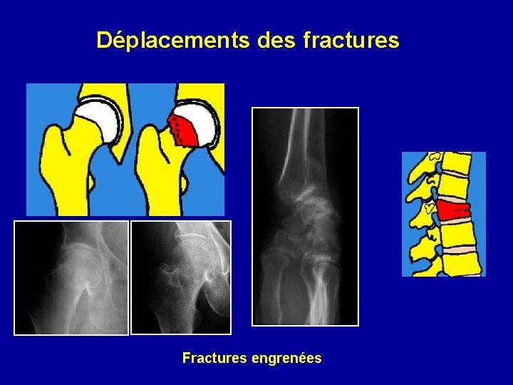 Déplacements des fractures Fractures engrenées 