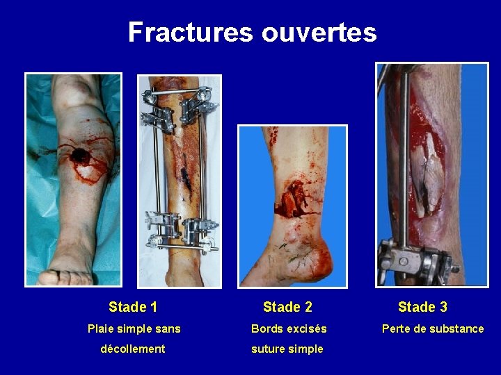 Fractures ouvertes Stade 1 Stade 2 Plaie simple sans Bords excisés décollement suture simple