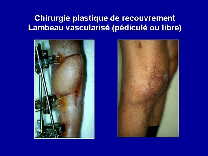 Chirurgie plastique de recouvrement Lambeau vascularisé (pédiculé ou libre) 