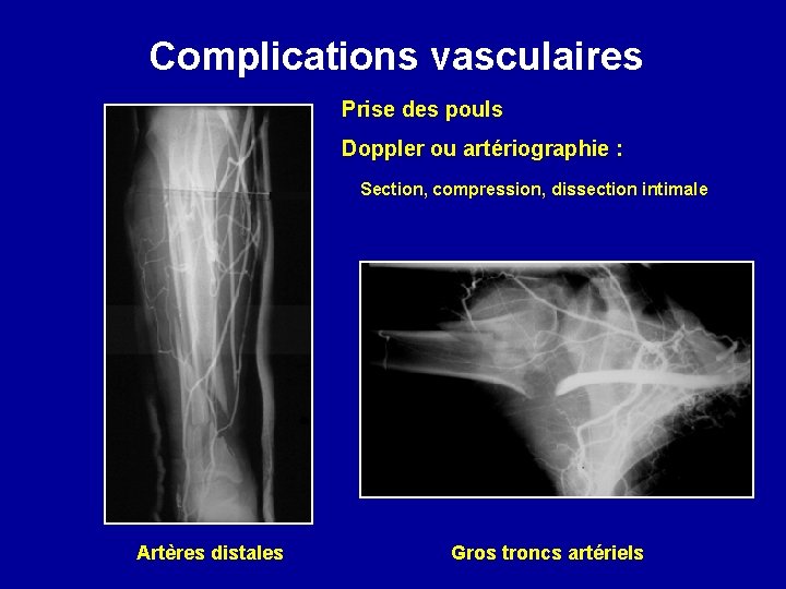 Complications vasculaires Prise des pouls Doppler ou artériographie : Section, compression, dissection intimale Artères