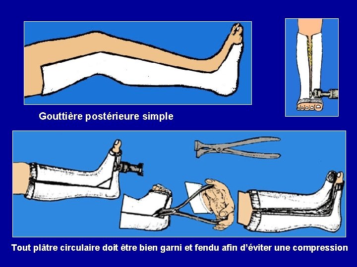 Gouttière postérieure simple Tout plâtre circulaire doit être bien garni et fendu afin d’éviter