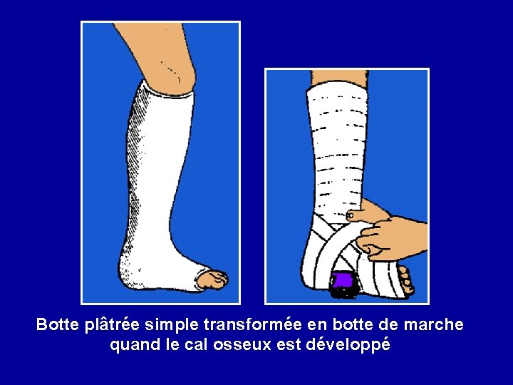 Botte plâtrée simple transformée en botte de marche quand le cal osseux est développé