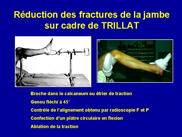 Réduction des fractures de la jambe sur cadre de TRILLAT Broche dans le calcaneum