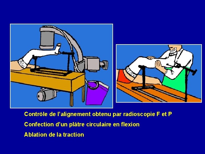 Contrôle de l’alignement obtenu par radioscopie F et P Confection d’un plâtre circulaire en