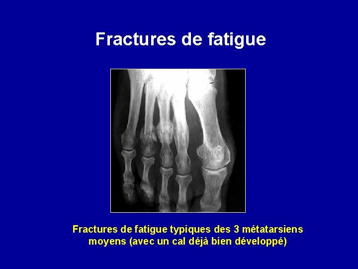 Fractures de fatigue typiques des 3 métatarsiens moyens (avec un cal déjà bien développé)