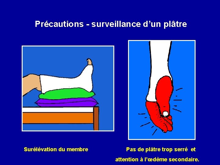 Précautions - surveillance d’un plâtre Surélévation du membre Pas de plâtre trop serré et