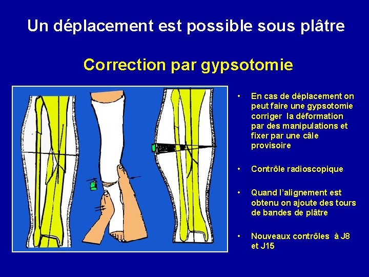 Un déplacement est possible sous plâtre Correction par gypsotomie • En cas de déplacement