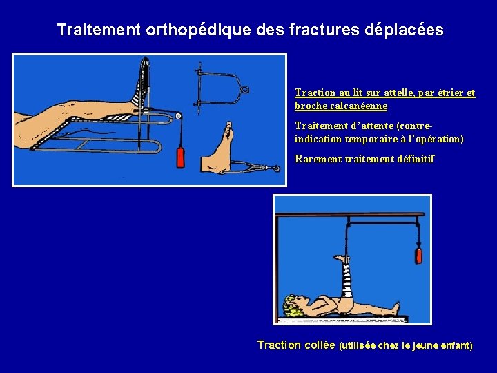 Traitement orthopédique des fractures déplacées Traction au lit sur attelle, par étrier et broche