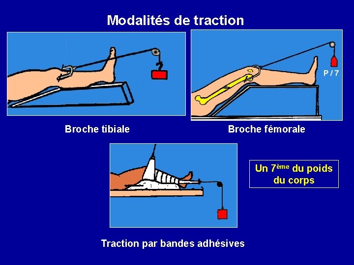 Modalités de traction Broche tibiale Broche fémorale Un 7ème du poids du corps Traction