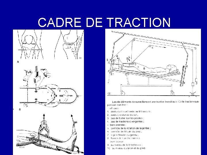 CADRE DE TRACTION 