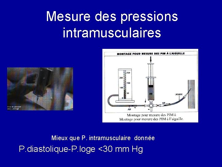 Mesure des pressions intramusculaires Mieux que P. intramusculaire donnée P. diastolique-P. loge <30 mm