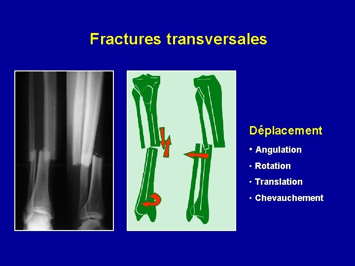 Fractures transversales Déplacement • Angulation • Rotation • Translation • Chevauchement 