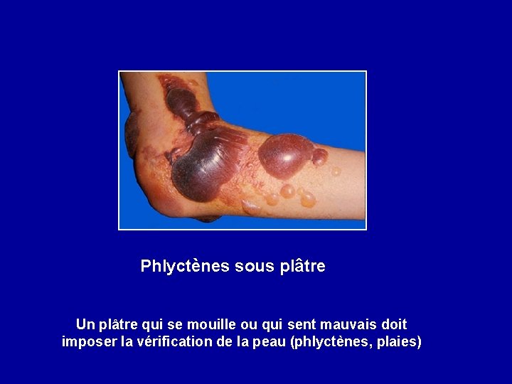 Phlyctènes sous plâtre Un plâtre qui se mouille ou qui sent mauvais doit imposer