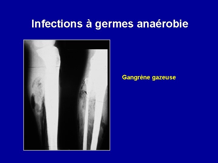 Infections à germes anaérobie Gangrène gazeuse 