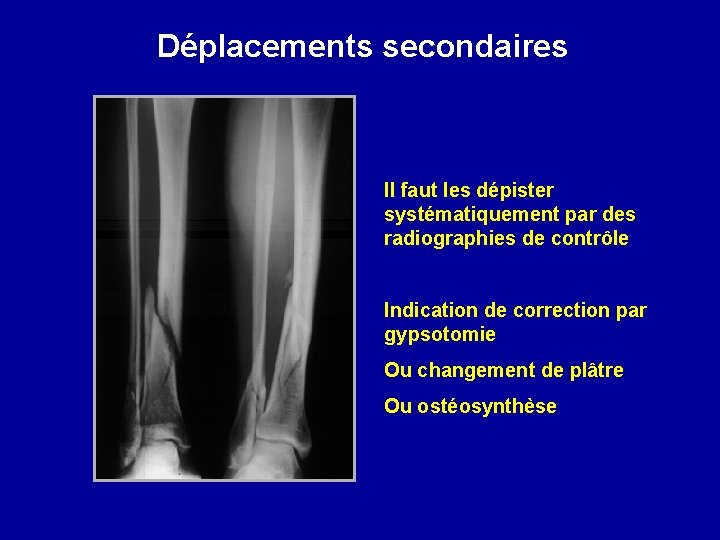 Déplacements secondaires Il faut les dépister systématiquement par des radiographies de contrôle Indication de