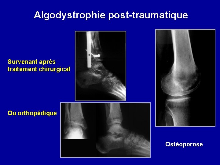 Algodystrophie post-traumatique Survenant après traitement chirurgical Ou orthopédique Ostéoporose 