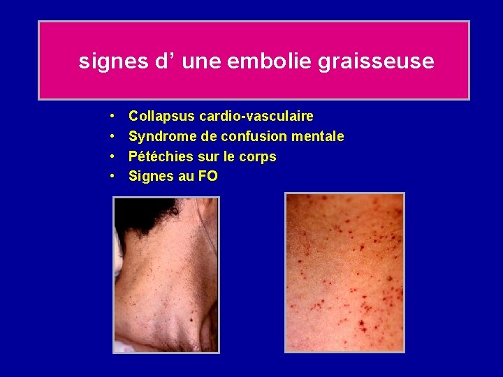 signes d’ une embolie graisseuse • • Collapsus cardio-vasculaire Syndrome de confusion mentale Pétéchies