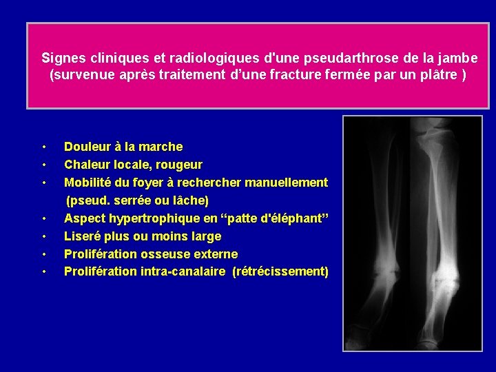 Signes cliniques et radiologiques d'une pseudarthrose de la jambe (survenue après traitement d’une fracture