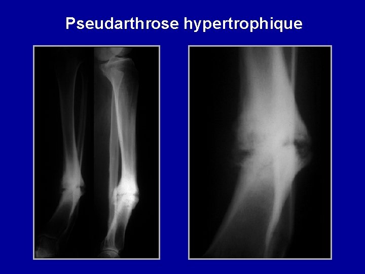 Pseudarthrose hypertrophique 
