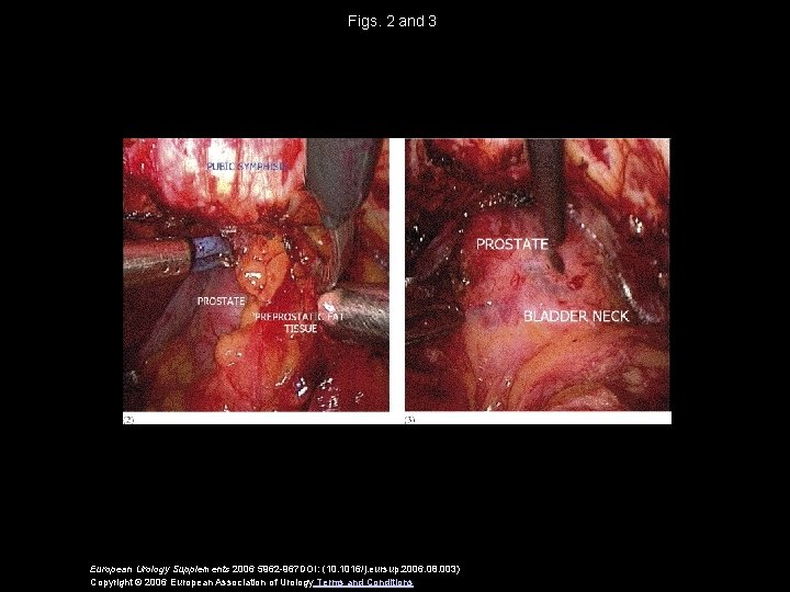 Figs. 2 and 3 European Urology Supplements 2006 5962 -967 DOI: (10. 1016/j. eursup.