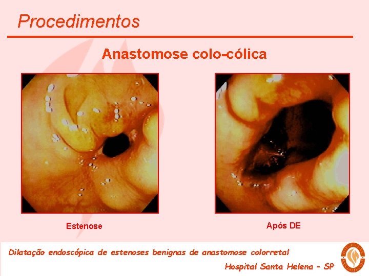 Procedimentos Anastomose colo-cólica Estenose Após DE Dilatação endoscópica de estenoses benignas de anastomose colorretal