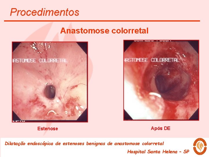 Procedimentos Anastomose colorretal Estenose Após DE Dilatação endoscópica de estenoses benignas de anastomose colorretal