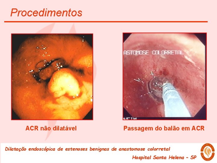 Procedimentos ACR não dilatável Passagem do balão em ACR Dilatação endoscópica de estenoses benignas