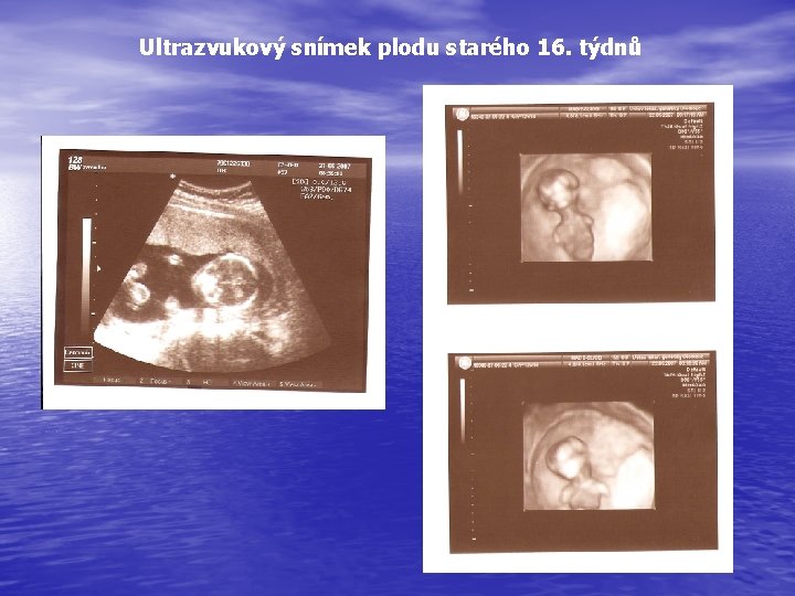 Ultrazvukový snímek plodu starého 16. týdnů 