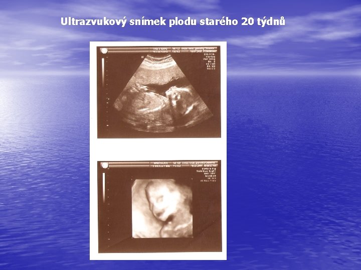 Ultrazvukový snímek plodu starého 20 týdnů 