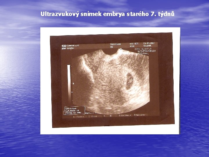 Ultrazvukový snímek embrya starého 7. týdnů 