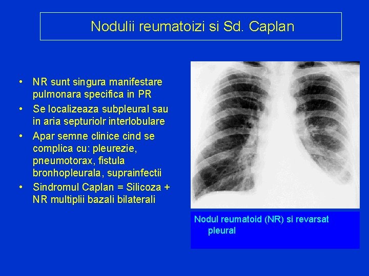 Nodulii reumatoizi si Sd. Caplan • NR sunt singura manifestare pulmonara specifica in PR