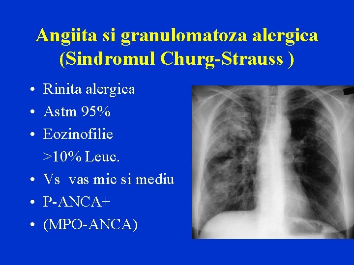 Angiita si granulomatoza alergica (Sindromul Churg-Strauss ) • Rinita alergica • Astm 95% •