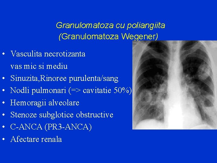 Granulomatoza cu poliangiita (Granulomatoza Wegener) • Vasculita necrotizanta vas mic si mediu • Sinuzita,