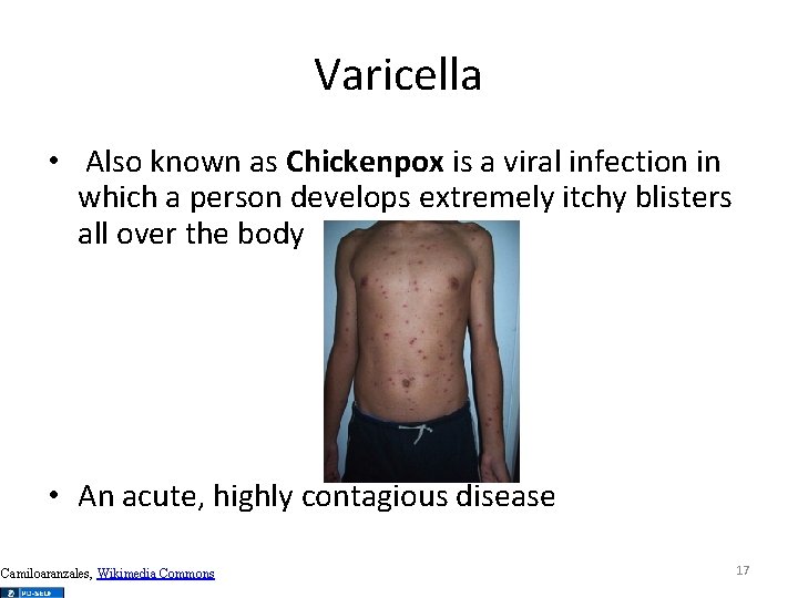 Varicella • Also known as Chickenpox is a viral infection in which a person