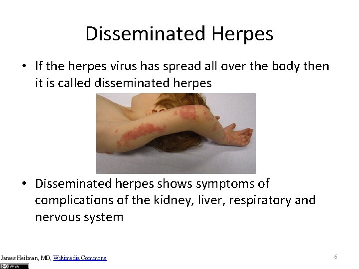 Disseminated Herpes • If the herpes virus has spread all over the body then