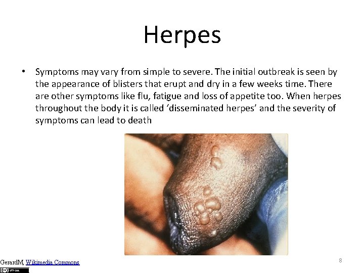 Herpes • Symptoms may vary from simple to severe. The initial outbreak is seen