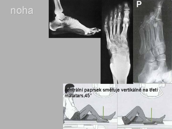 noha centrální paprsek směřuje vertikálně na třetí matatars, 45° 