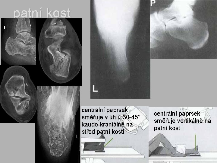 patní kost centrální paprsek směřuje v úhlu 30 -45° kaudo-kraniálně na střed patní kosti