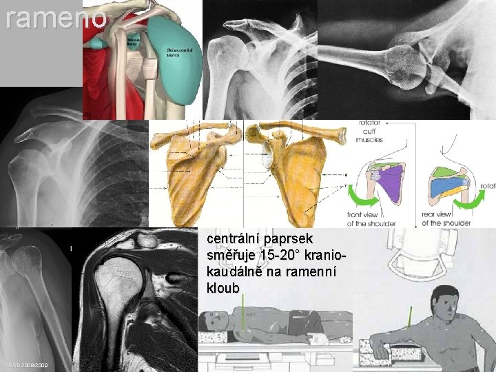 rameno centrální paprsek směřuje 15 -20° kraniokaudálně na ramenní kloub ARAD 2008/2009 centrální paprsek
