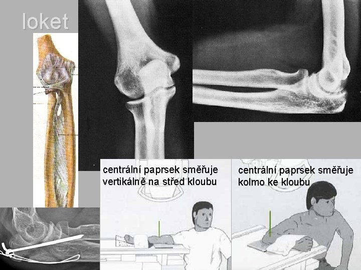 loket centrální paprsek směřuje vertikálně na střed kloubu centrální paprsek směřuje kolmo ke kloubu