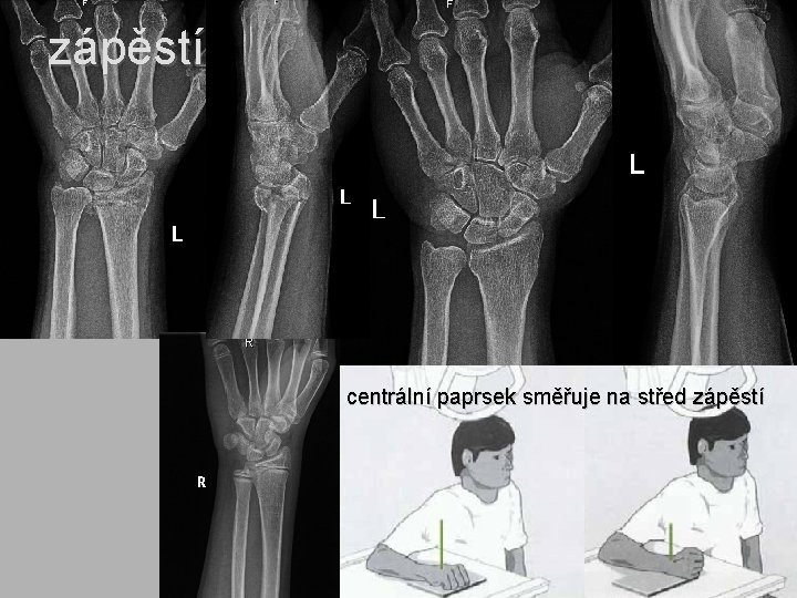 zápěstí centrální paprsek směřuje na střed zápěstí 