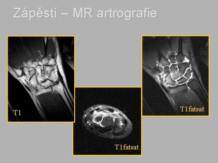 Zápěstí – MR artrografie T 1 fatsat 