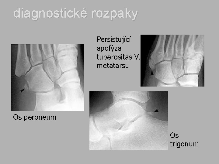 diagnostické rozpaky Persistující apofýza tuberositas V. metatarsu Os peroneum Os trigonum 