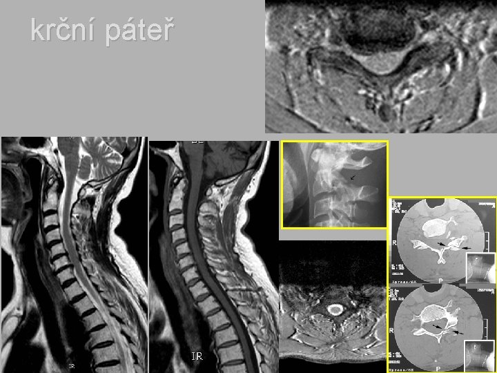 krční páteř 